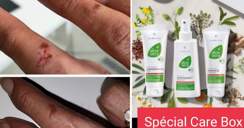 Comment cicatriser rapidement et proprement sans croûtes